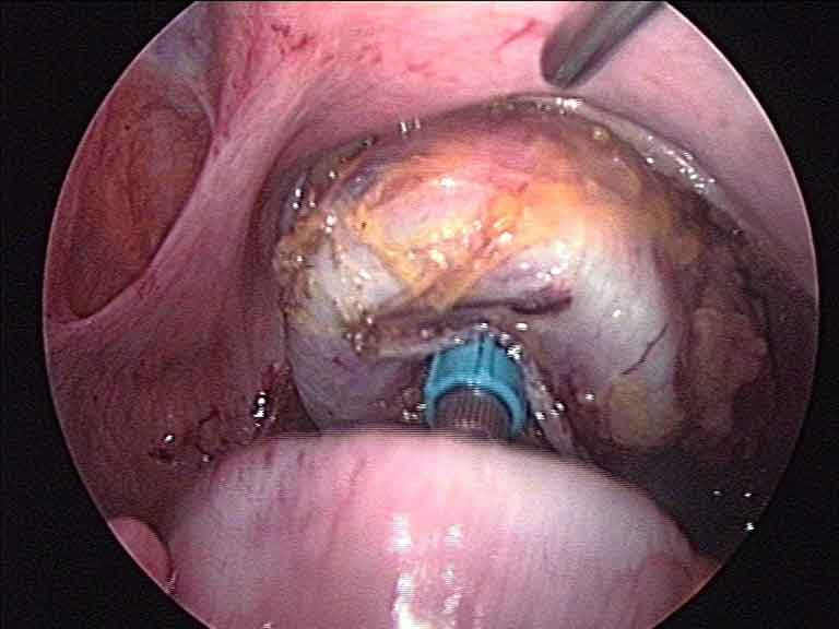 Laparoscopic rectal cancer surgery — stapled anastomosis view