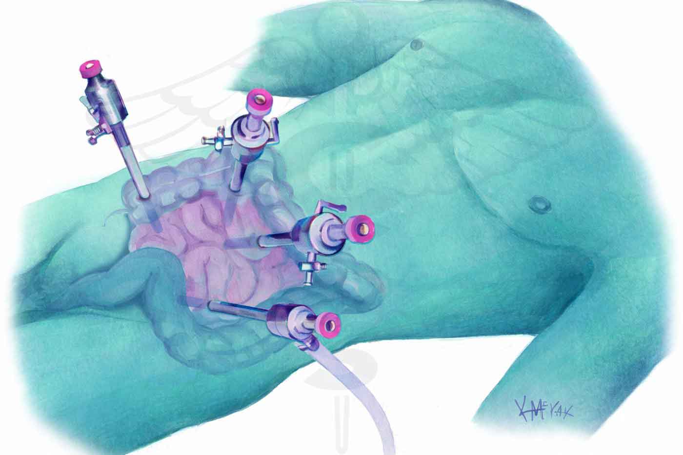 Medical illustration showing laparoscopic port placement for appendiceal surgery