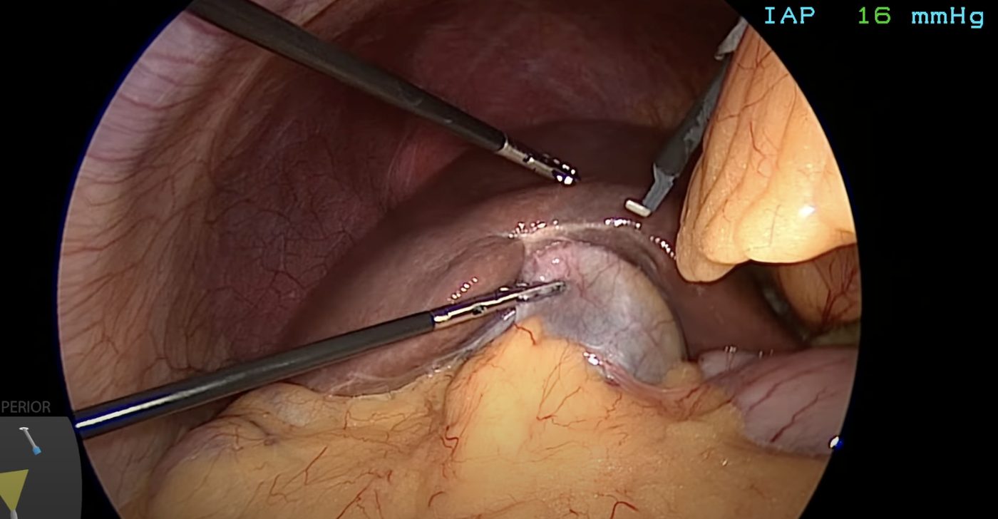 Laparoscope camera inserted through port — live view inside abdomen