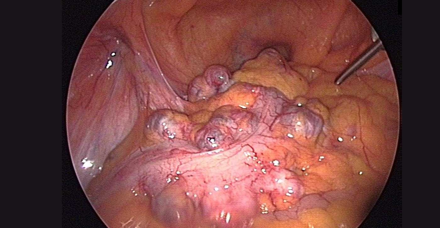 Live laparoscopic view inside abdomen during surgery