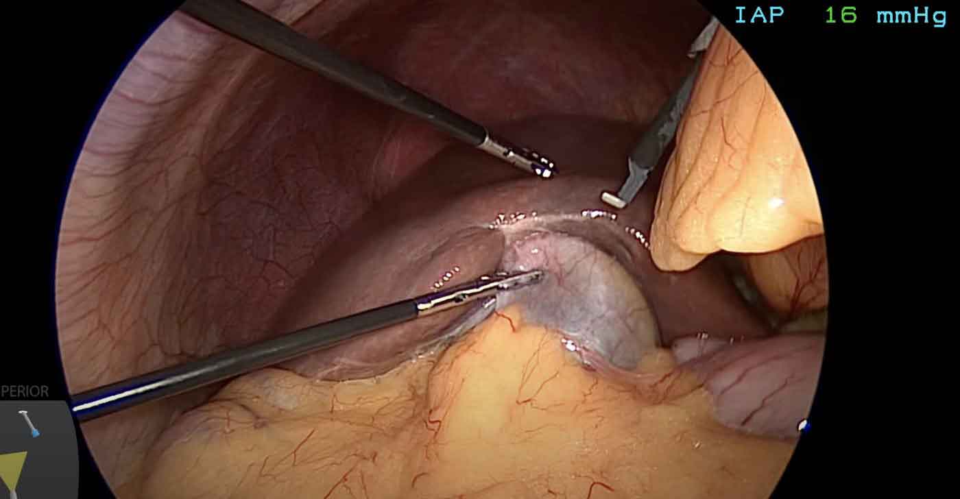 Intraoperative laparoscopic view during cholecystectomy showing gallbladder dissection