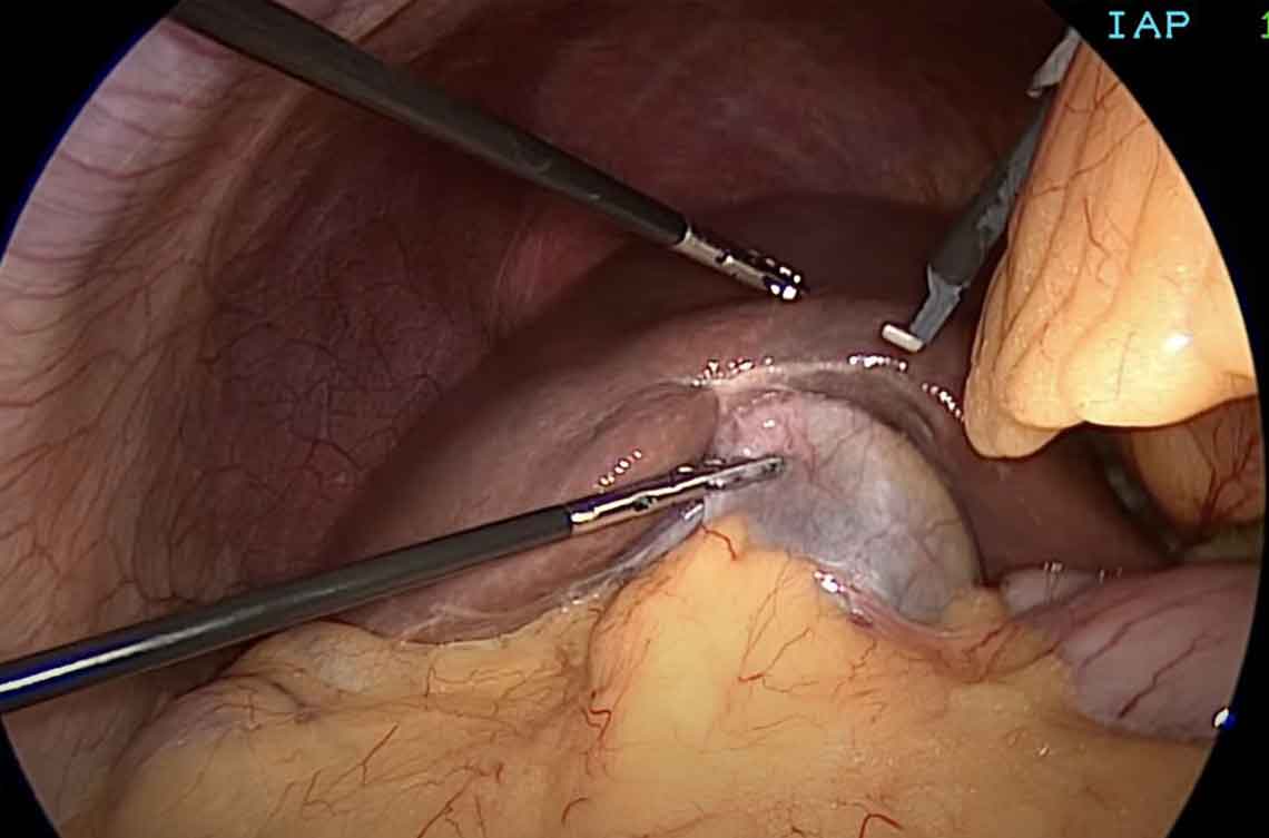 Laparoscopic view during gallbladder surgery showing precise dissection