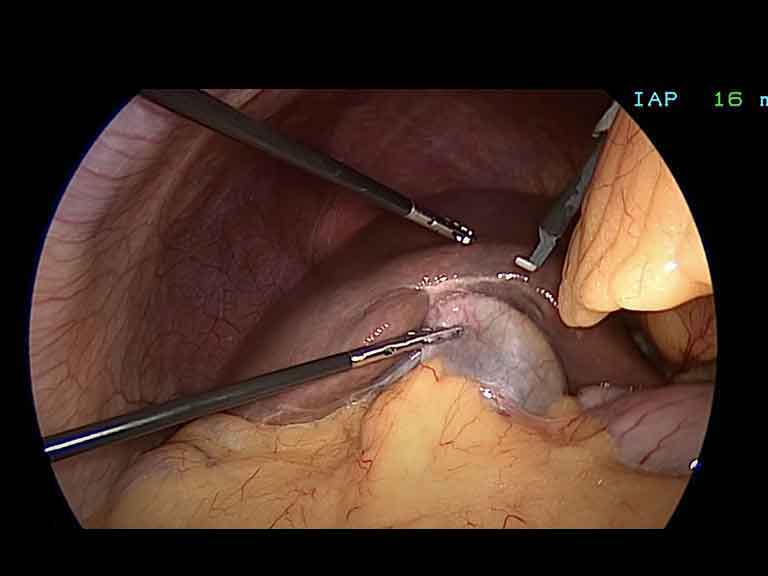 Laparoscopic cholecystectomy — intraoperative view of gallbladder removal