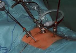 Laparoscopic TAPP inguinal hernia surgery — keyhole approach with camera guidance
