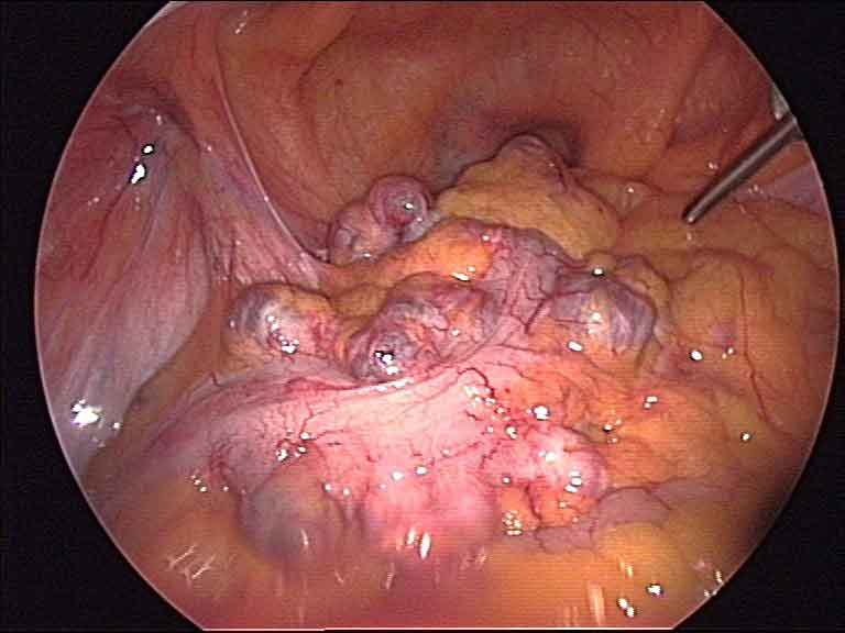 Laparoscopic view inside abdomen during colon cancer surgery