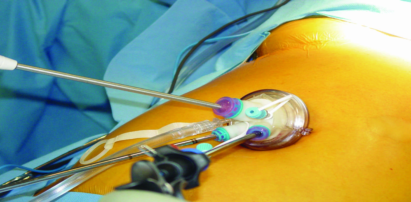 Small ports inserted in abdomen for laparoscopic surgery