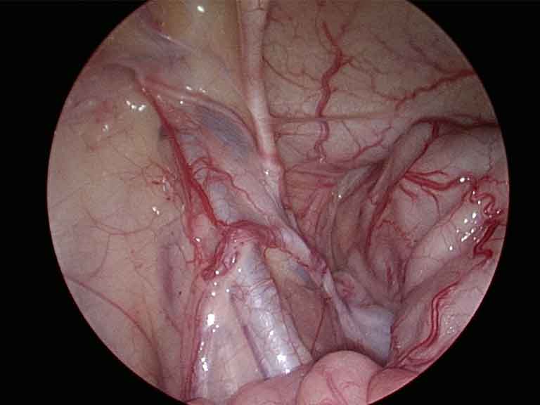 Laparoscopic view during abdominal wall hernia repair