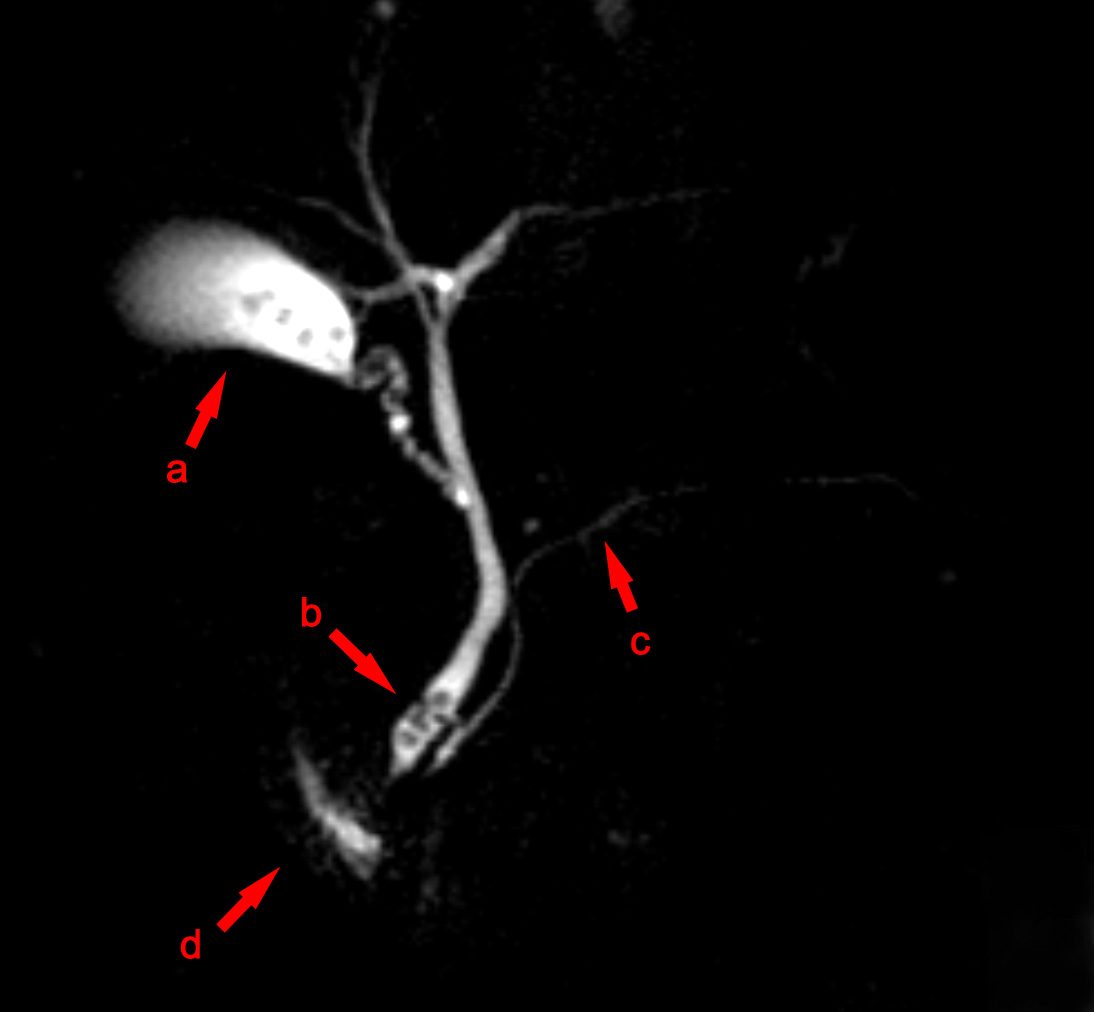 MRCP scan showing stones in the common bile duct — choledocholithiasis