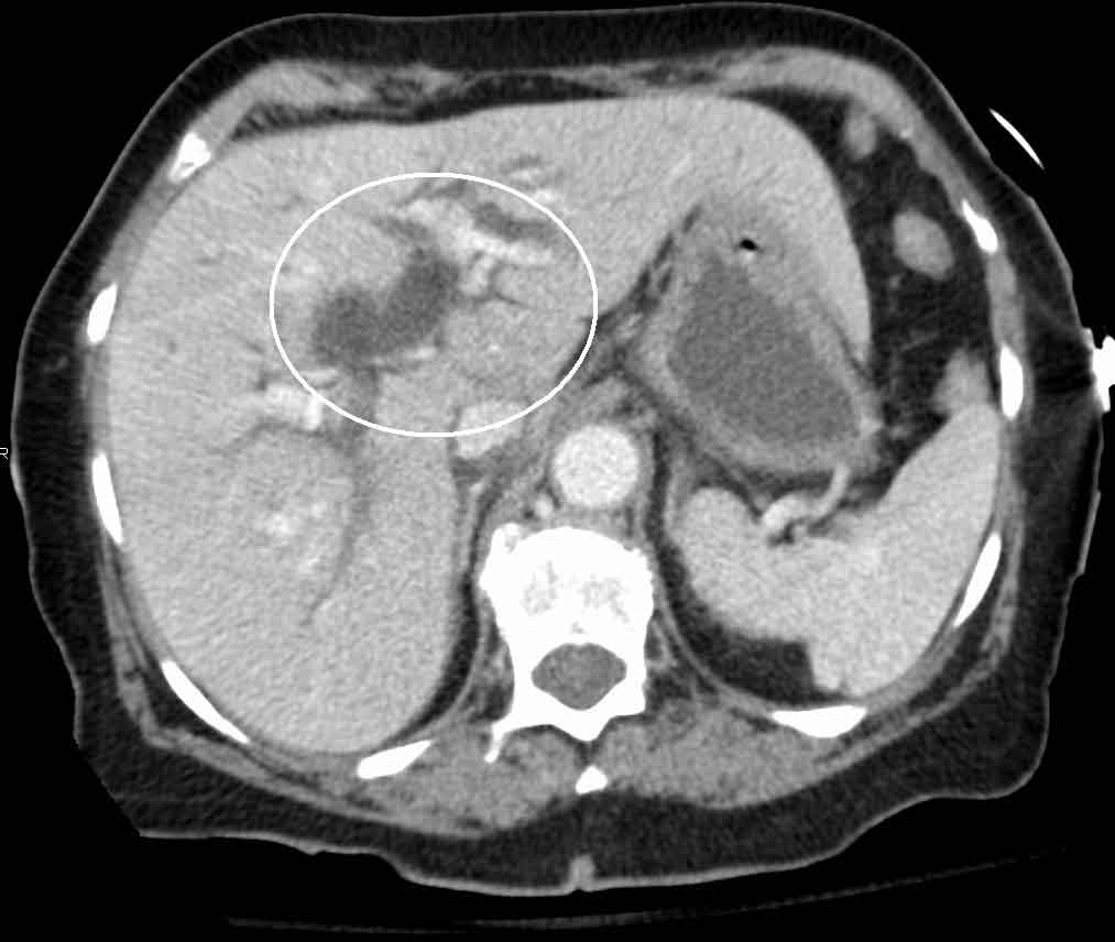 Imaging showing dilated common bile duct due to obstructing gallstone