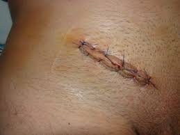 Open Lichtenstein inguinal hernia repair — groin incision and mesh placement