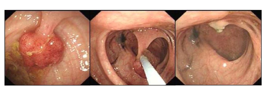 Polypectomy — removal of a colon polyp using a wire snare during colonoscopy