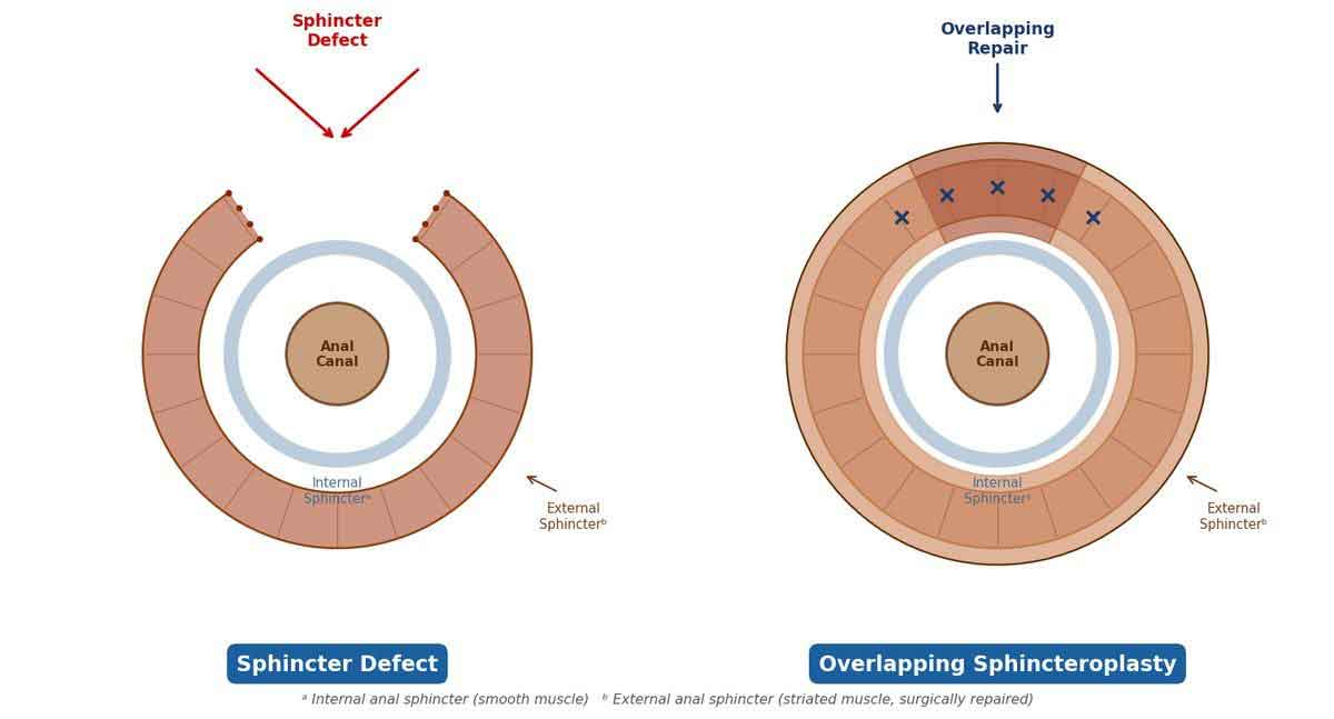 Diagram showing sphincter defect (left) and overlapping sphincteroplasty repair (right)
