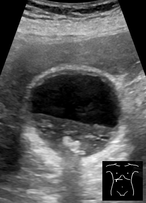 Ultrasound scan showing gallbladder sludge and multiple gallstones