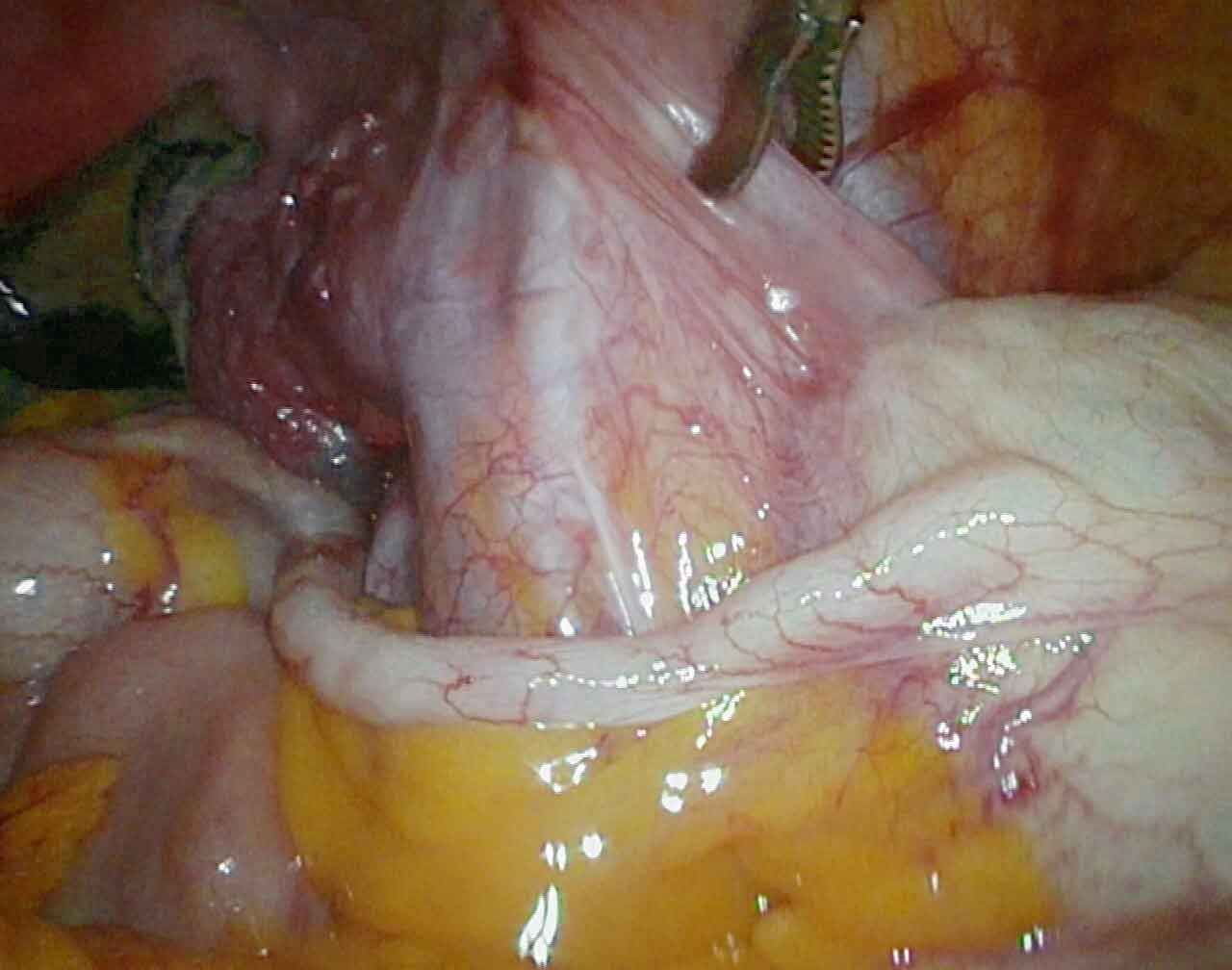 Laparoscopic view of the vermiform appendix during appendicectomy at Fortis Hospital Mohali