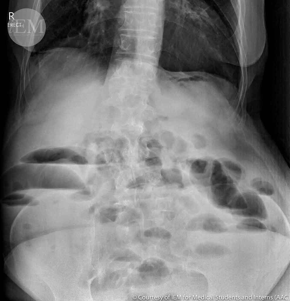 Erect abdominal X-ray showing dilated loops of small bowel with air-fluid levels — classic sign of intestinal obstruction