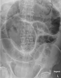 Supine abdominal X-ray showing pattern of large bowel dilation in intestinal obstruction