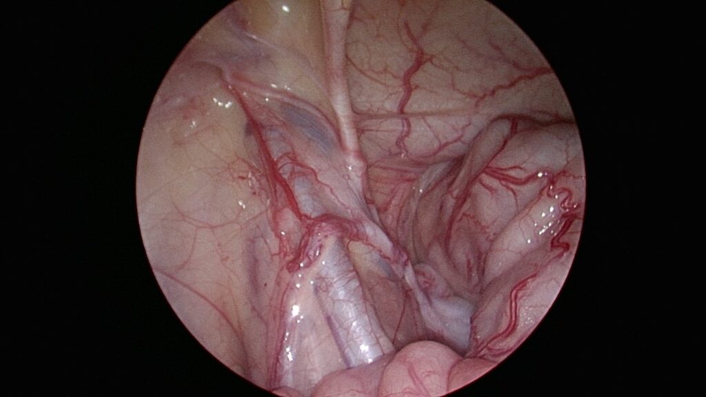 adhesion obstruction