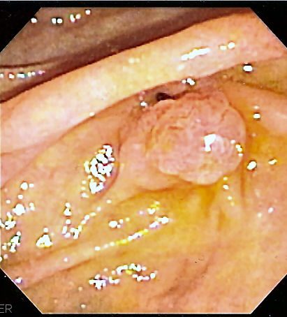 Is Appendiceal Cancer Curable?