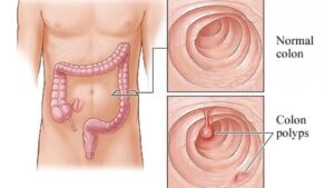 colonoscopy prep