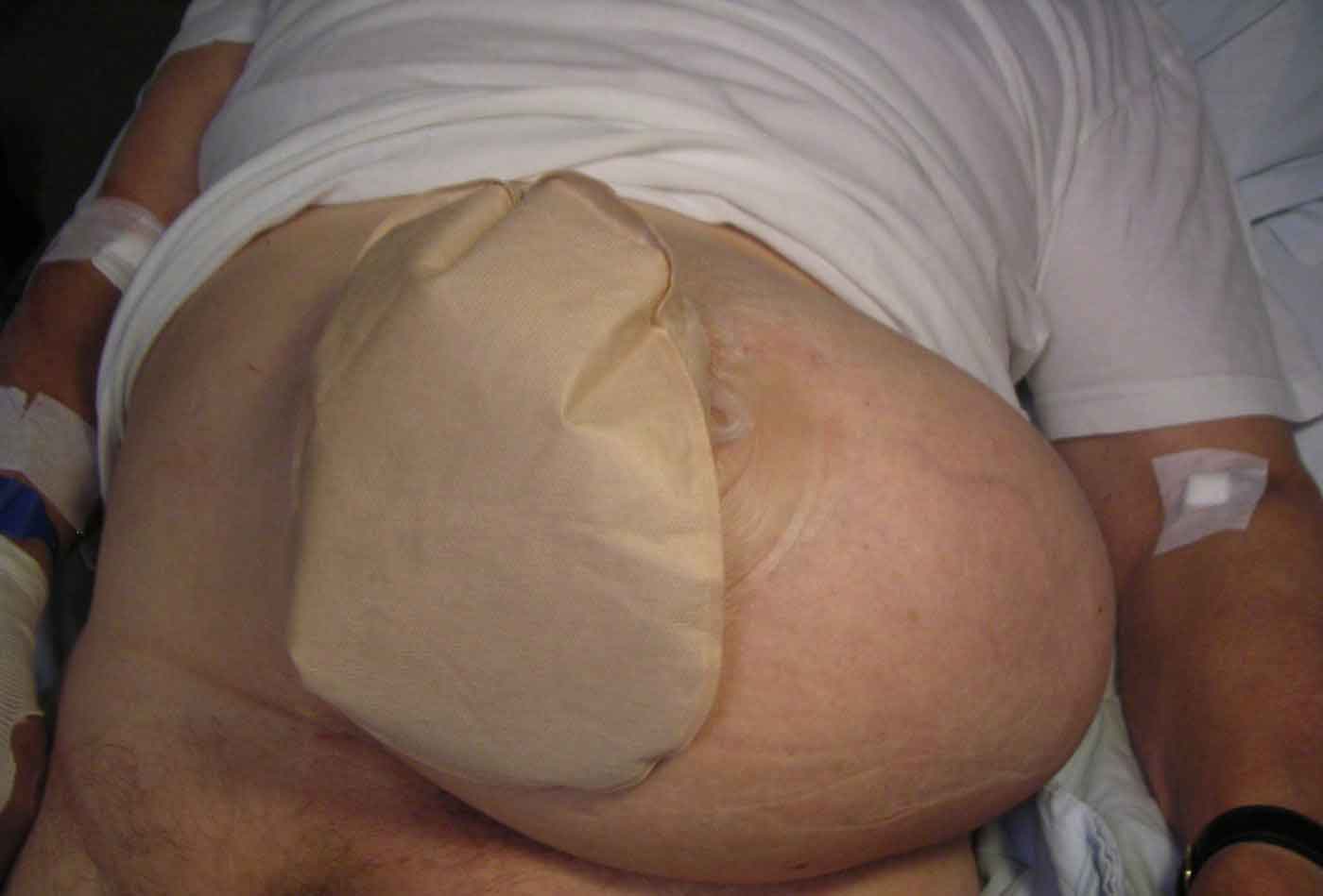 Colostomy with parastomal hernia — clinical view