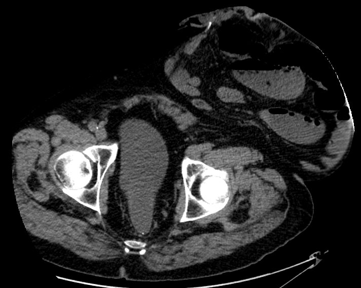 CT scan showing parastomal hernia