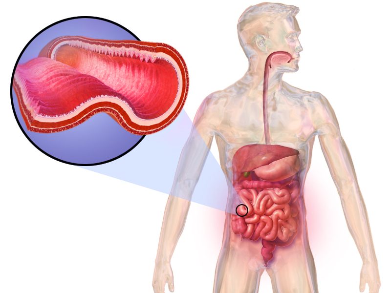 crohns fistula