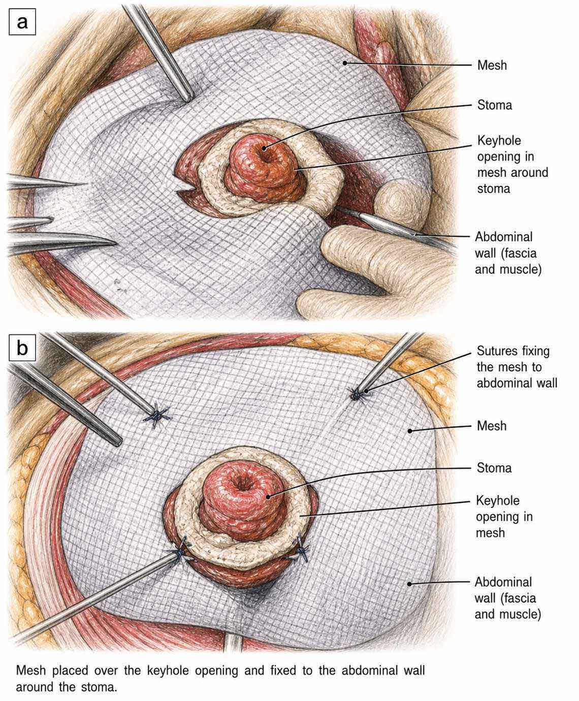 End stoma parastomal hernia repair showing same-site technique