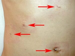 fistula recovery