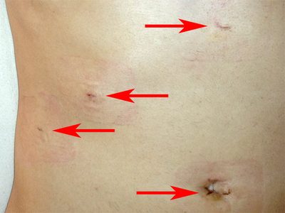 fistula recovery