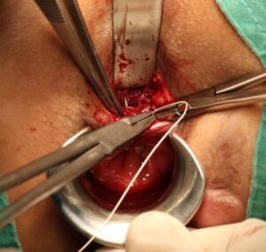 fistula recurrence