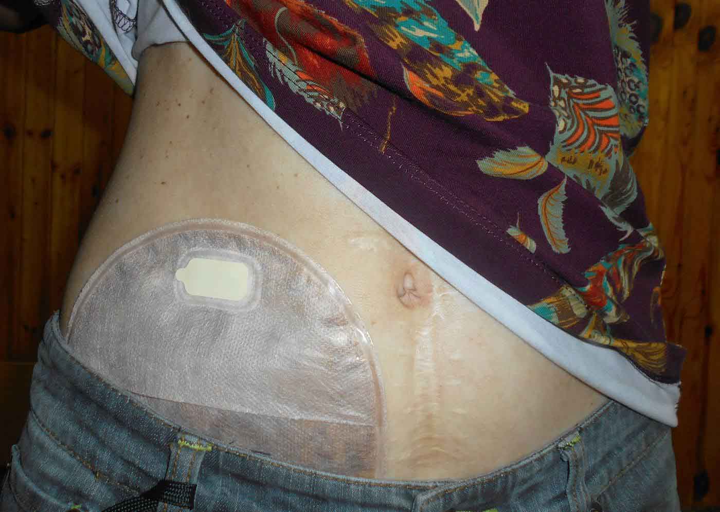 Well-healed stoma with properly fitting appliance after parastomal hernia repair