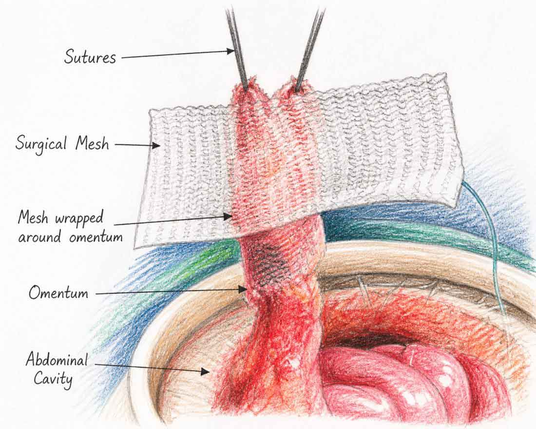 Open mesh repair of parastomal hernia — mesh placed around the stoma with sutures narrowing the fascial defect. (AI-Generated Illustration)