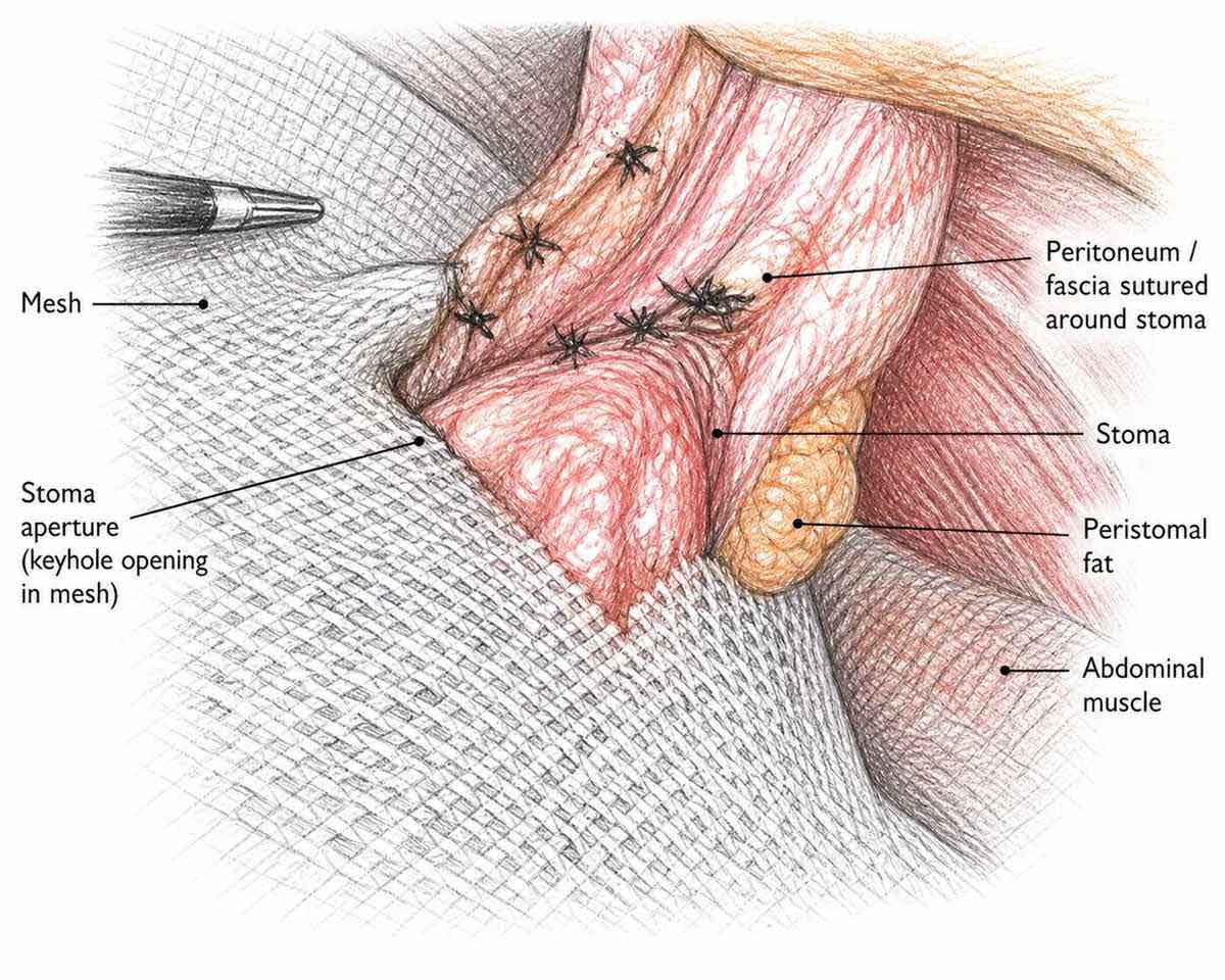 Open surgical repair with mesh for parastomal hernia