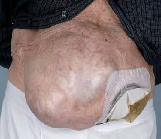Parastomal hernia visible bulge around stoma site