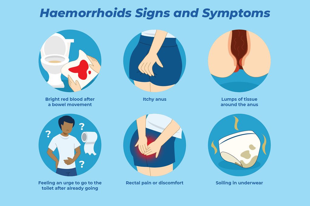 When Should Piles (Hemorrhoids) Be Treated Surgically in Chandigarh?