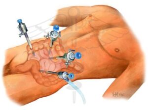 post hernia advice