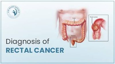 rectal neoadjuvant
