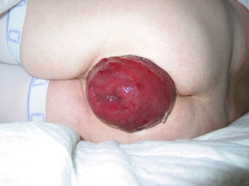 rectal prolapse