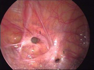 recurrent hernia