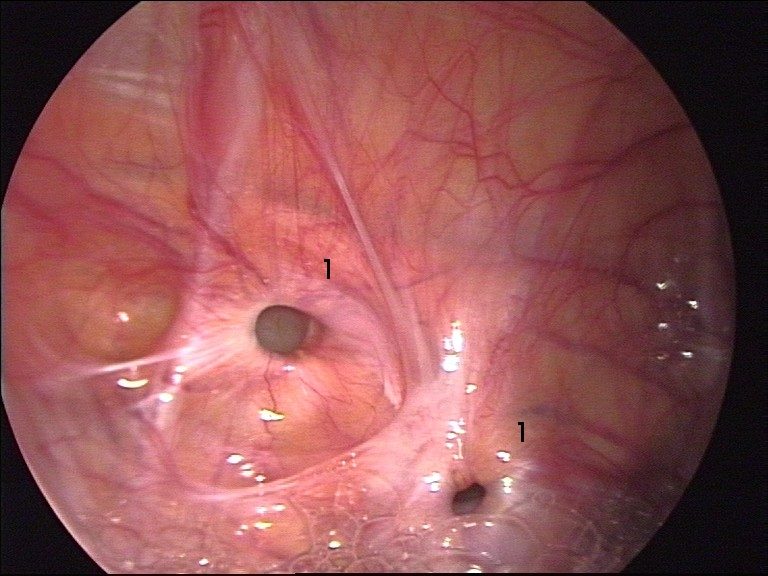 recurrent hernia