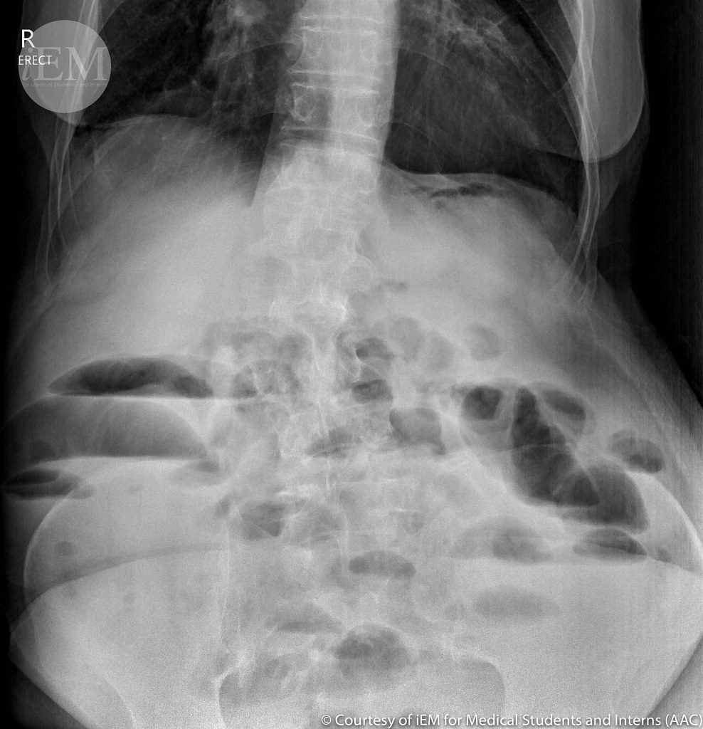 small bowel obstruction
