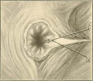 sphincteroplasty