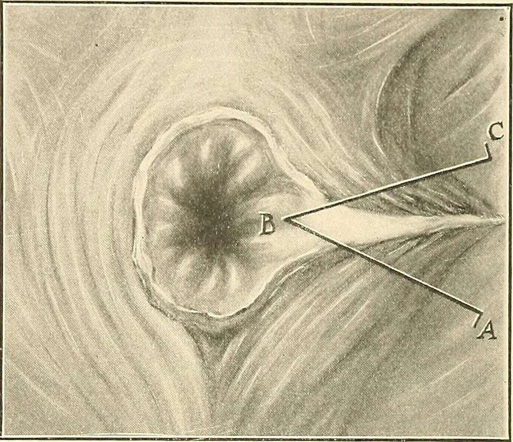 sphincteroplasty