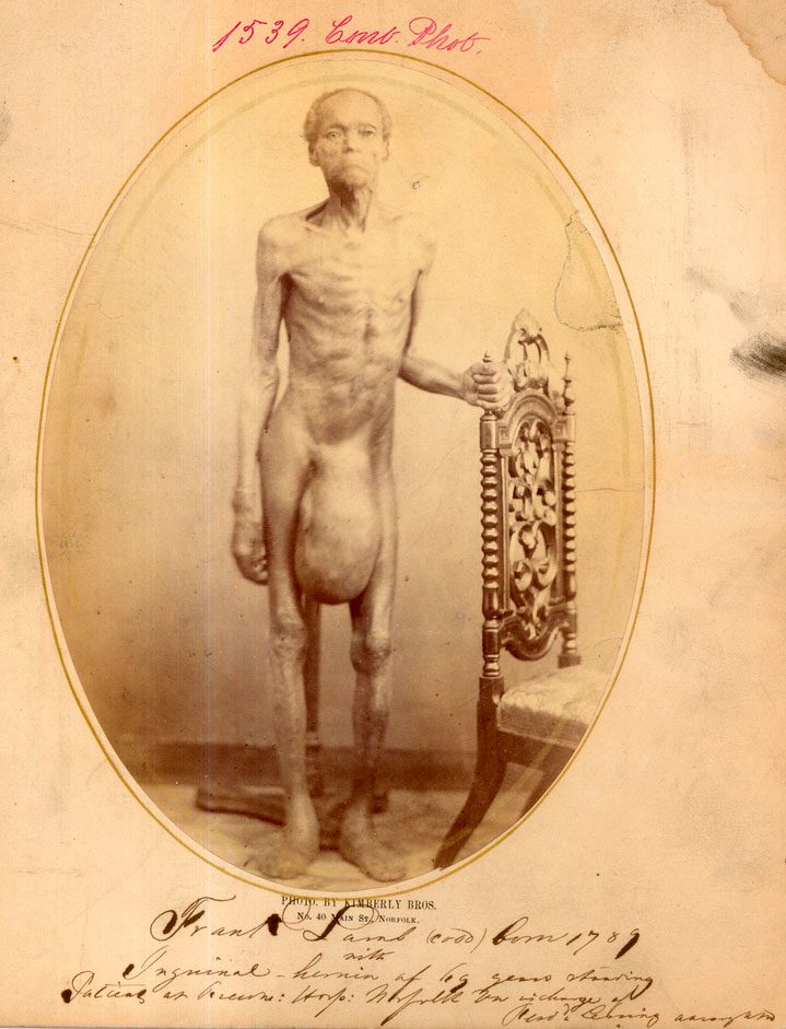story hernia