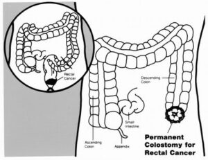 story stoma